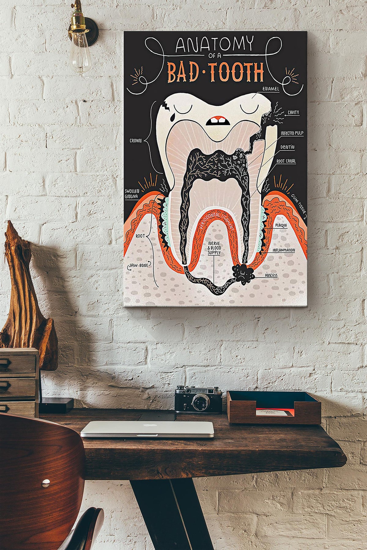 Anatomy Of A Bad Tooth Denist Poster Canvas Gallery Wrapped Canvas Framed Gift Idea